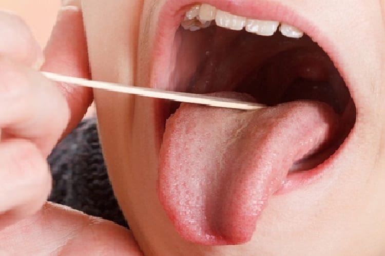 Dry Mouth