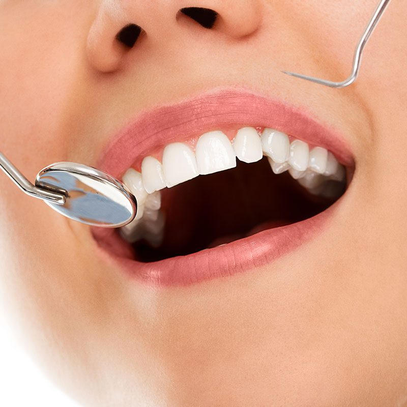 teeth whitening