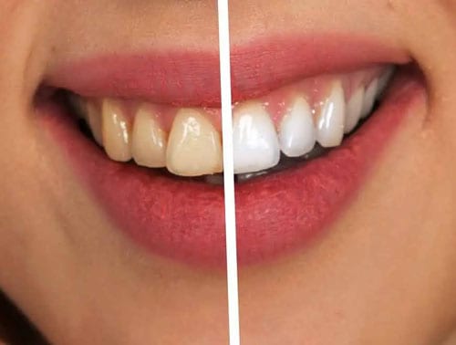 Dental Fluorosis