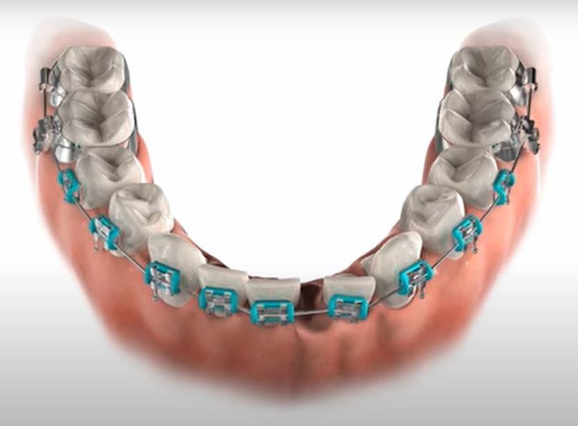 Dental crowding
