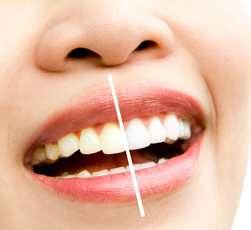 Tooth Cleaning and Aftercare
