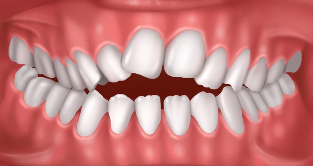 Open Bite