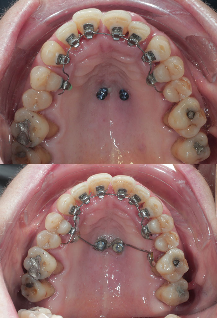 Anchorage in Orthodontics