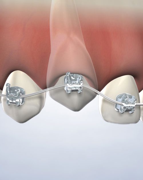 Impacted Canine