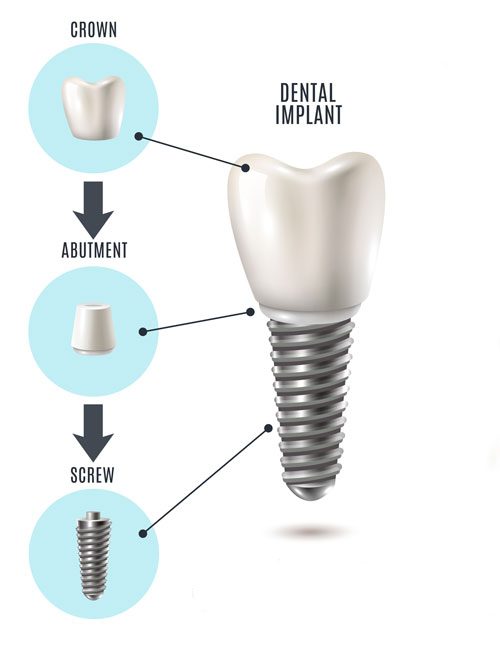 implant procedure