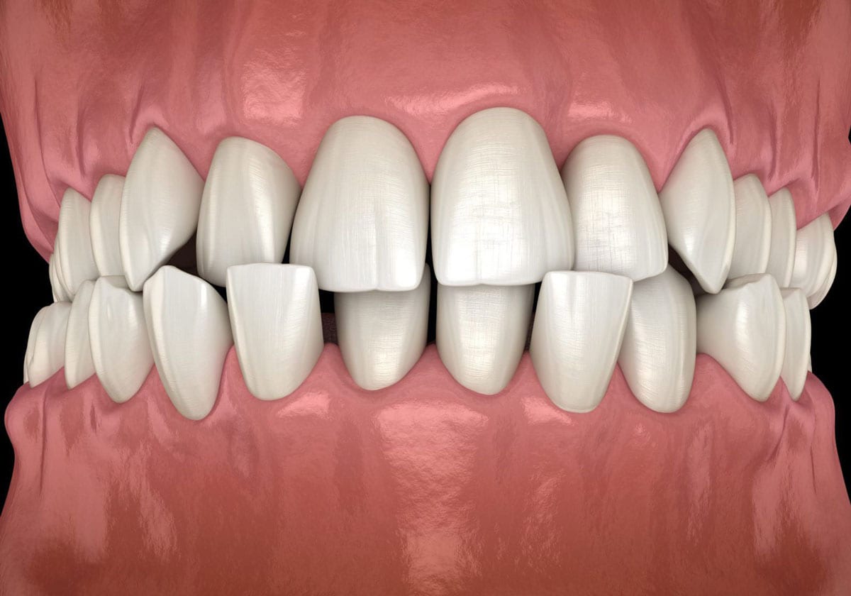 crossbite