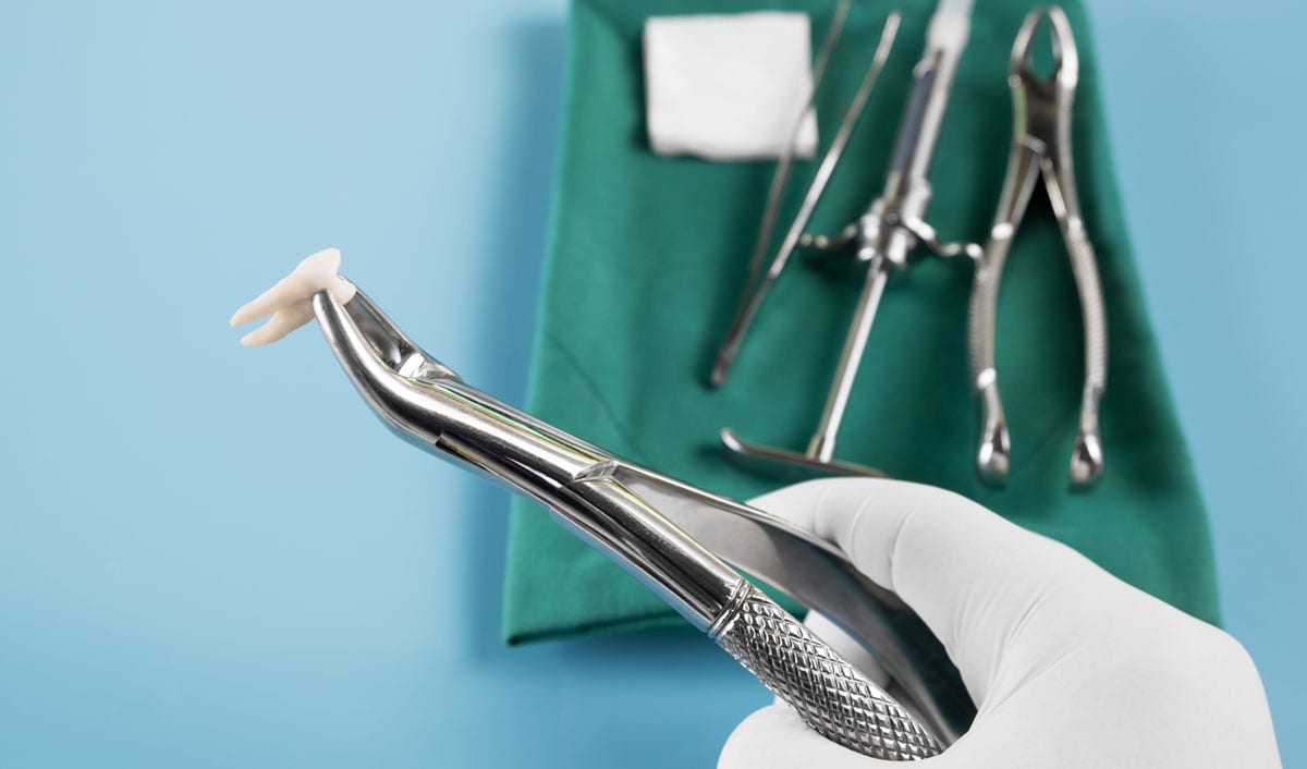 Tooth Extraction