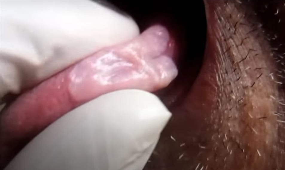 Leukoplakia