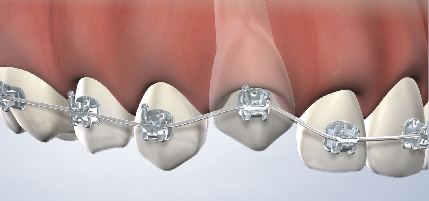 Impacted Canine