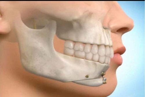 teeth grinding