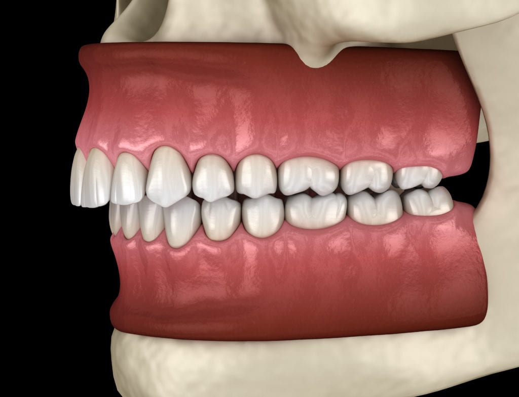 What Is An Overbite
