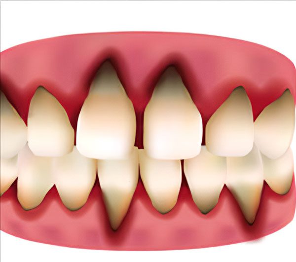 Gum Recession