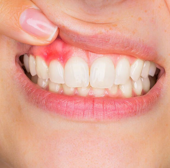 Swollen gums