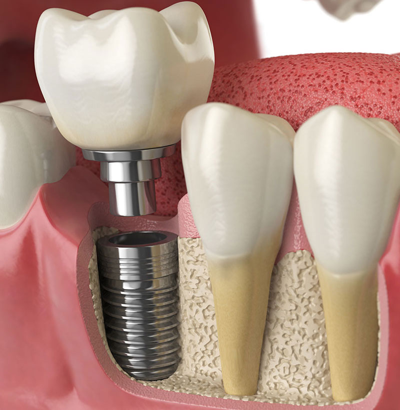 Bone Grafting