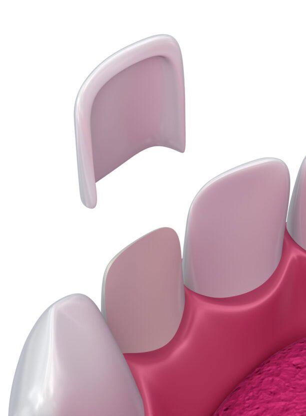 How Do Veneers Work?