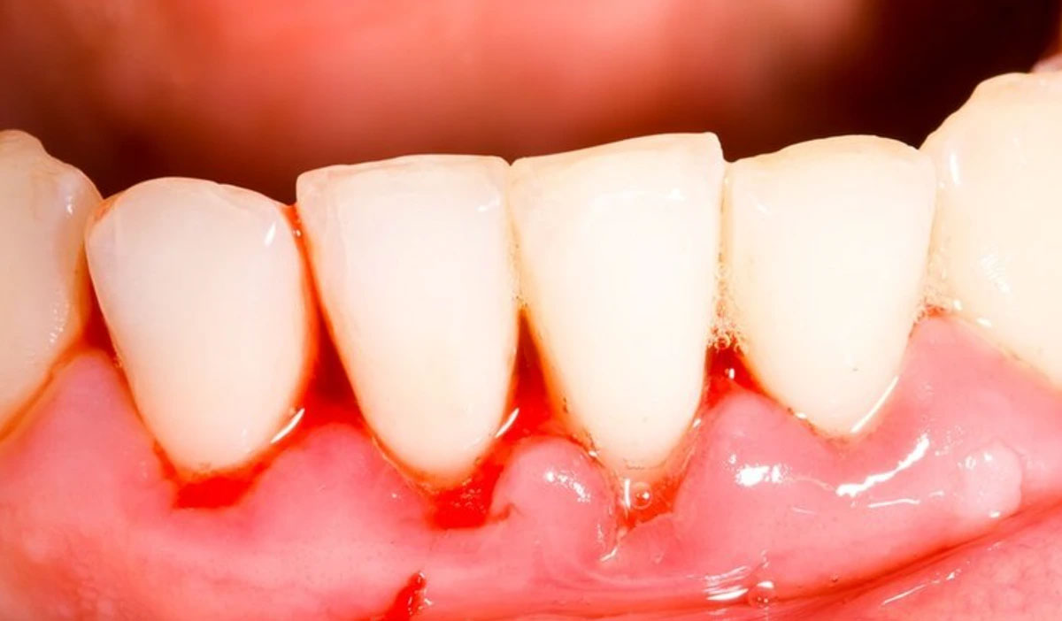 Swollen gums
