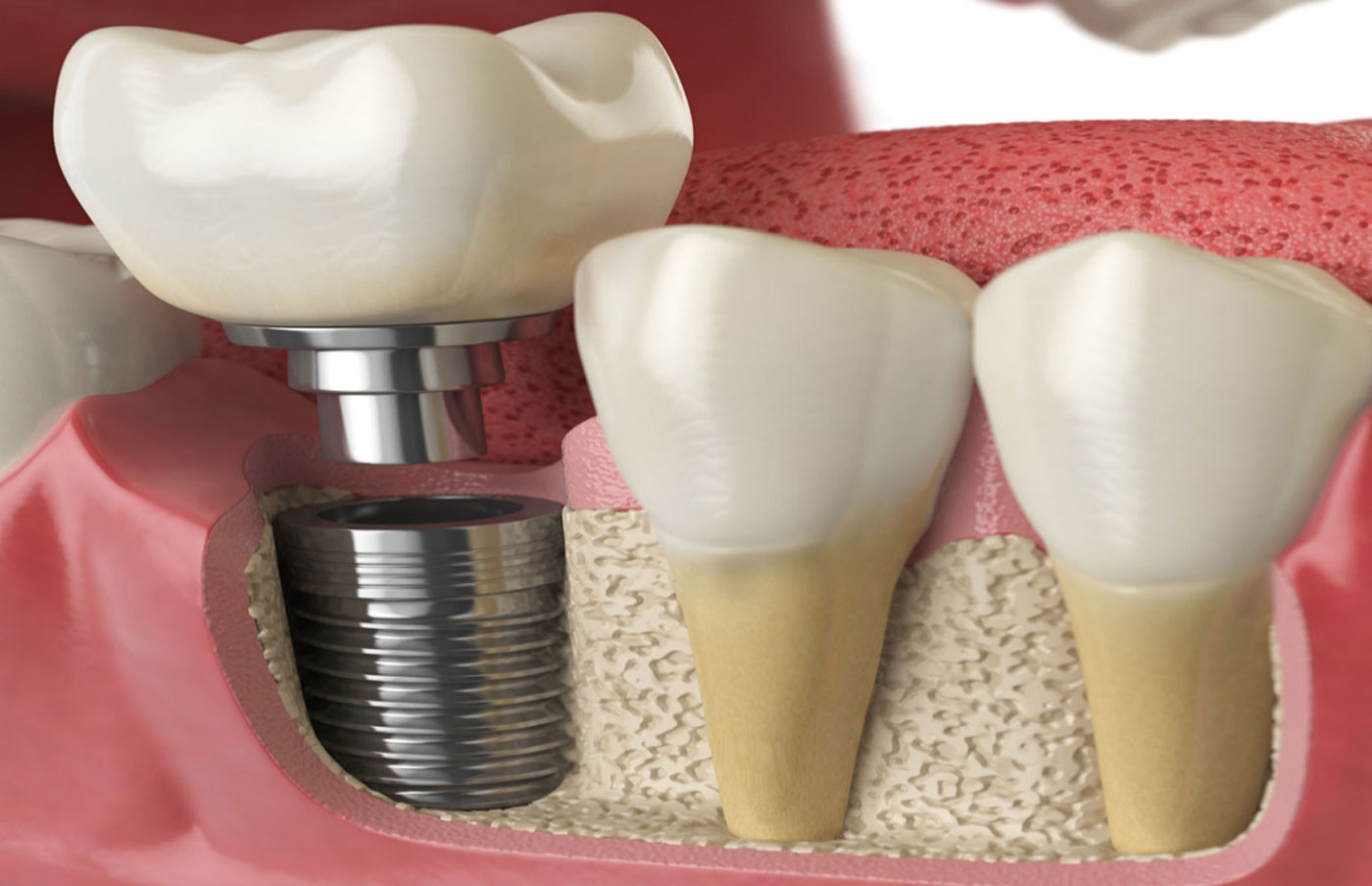 Bone Grafting
