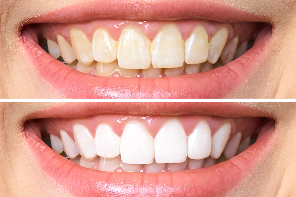 Yellow Teeth