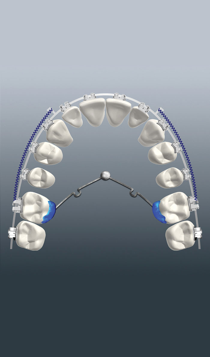 Anchorage in Orthodontics