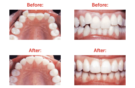Dental crowding