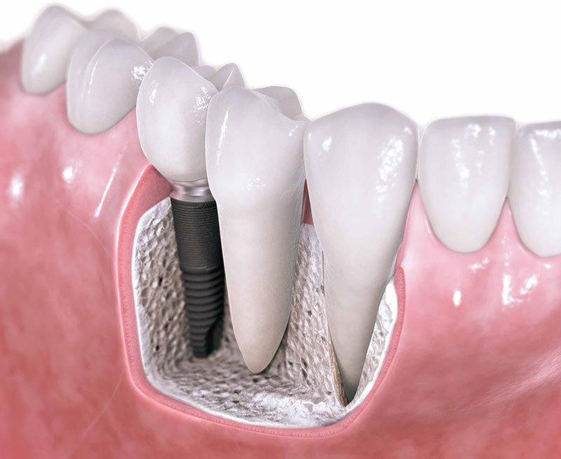Bone Grafting