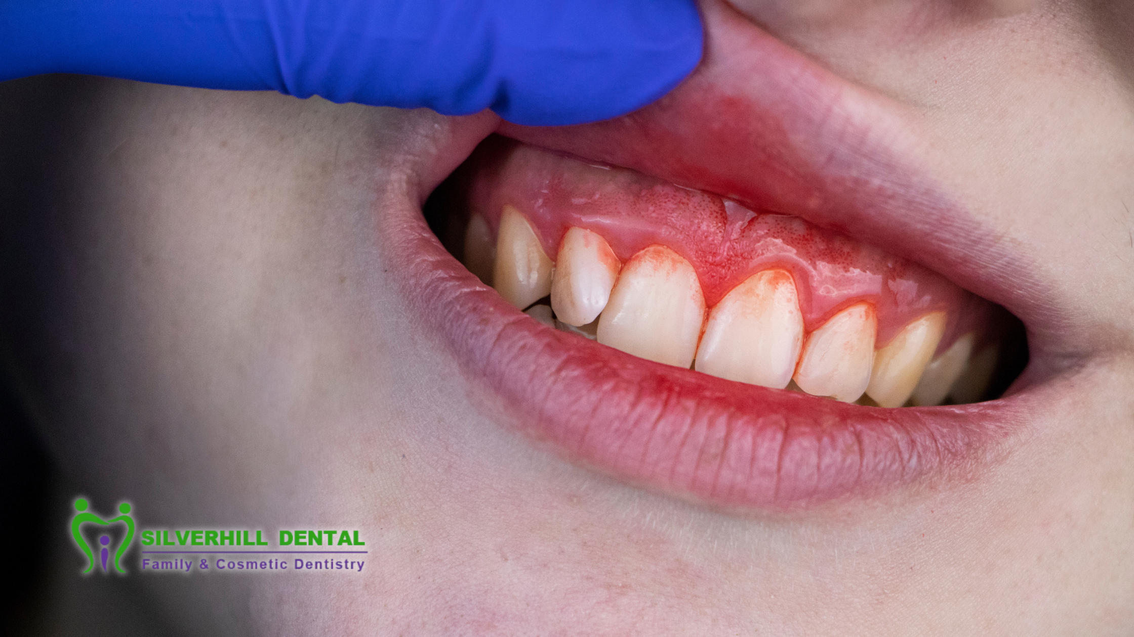 Why Your Gums Bleed and What to Do About It