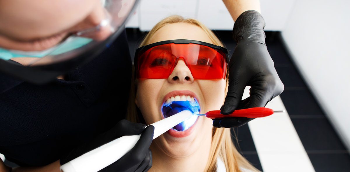 Composite Fillings