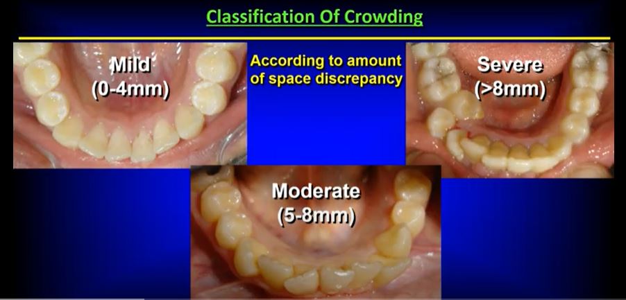 Dental crowding