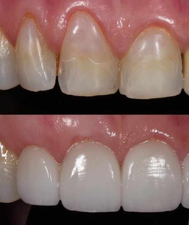 Gum Recession