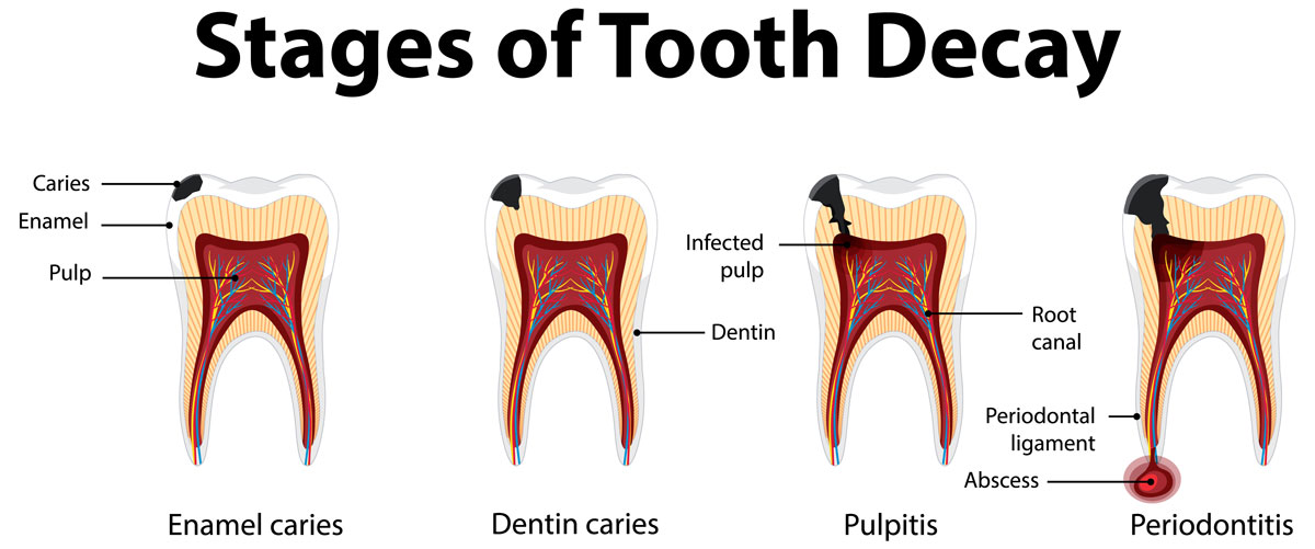 Why Do The Teeth Begin to Deteriorate
