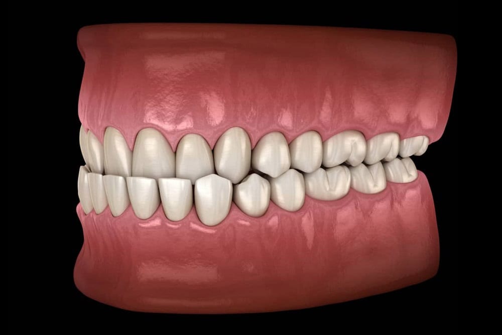 Underbite Types And Correction