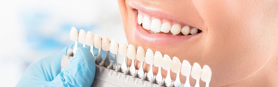How Do Veneers Work?