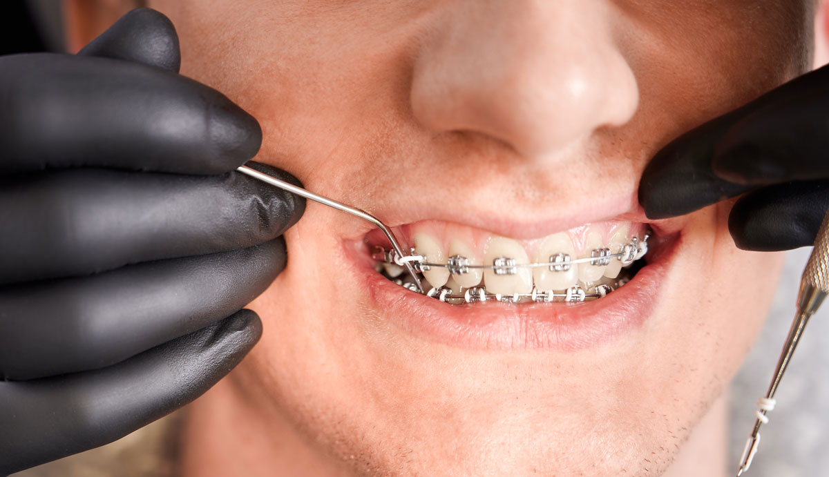 10 Things to Know When Getting Braces
