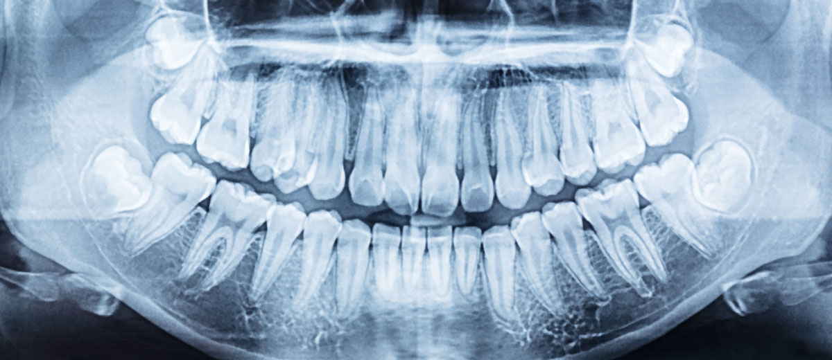 Wisdom Tooth