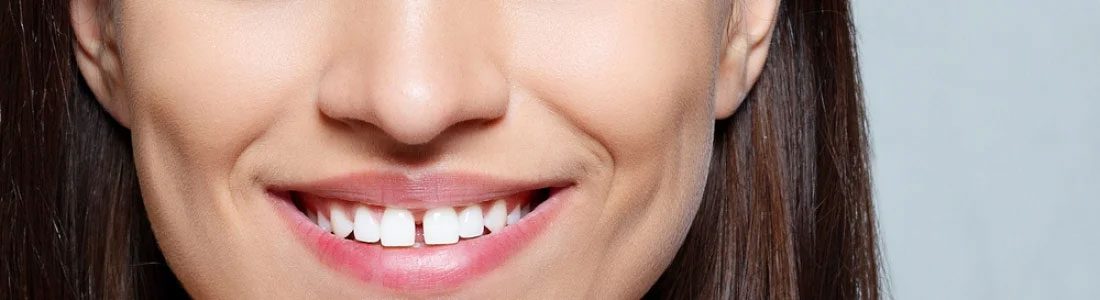 Space in Teeth
