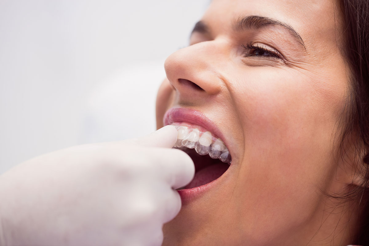 types of braces