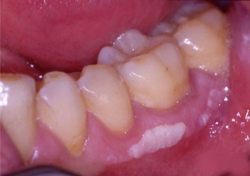 Leukoplakia: Causes, Symptoms, Treatment