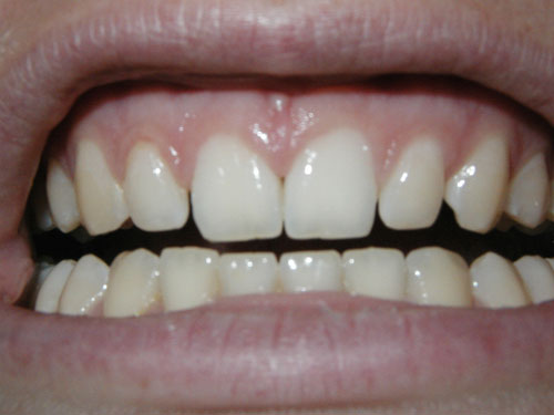 Gingivitis