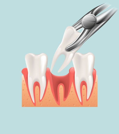 Tooth Extraction