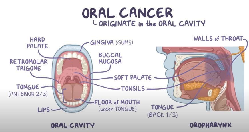 oral cancer