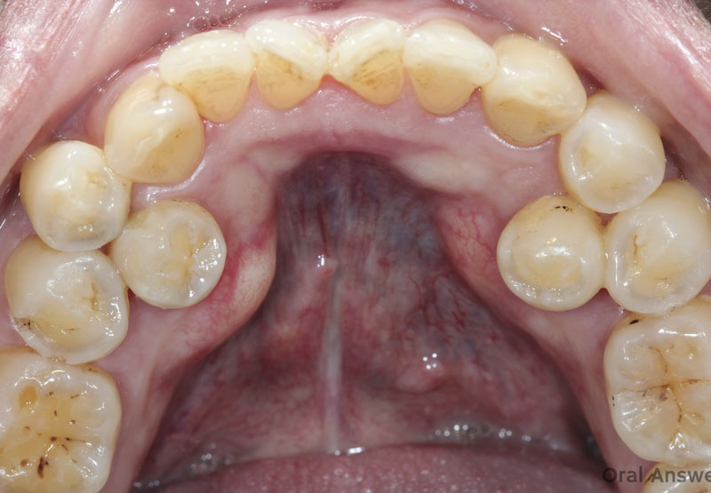 What Is Hyperdontia?