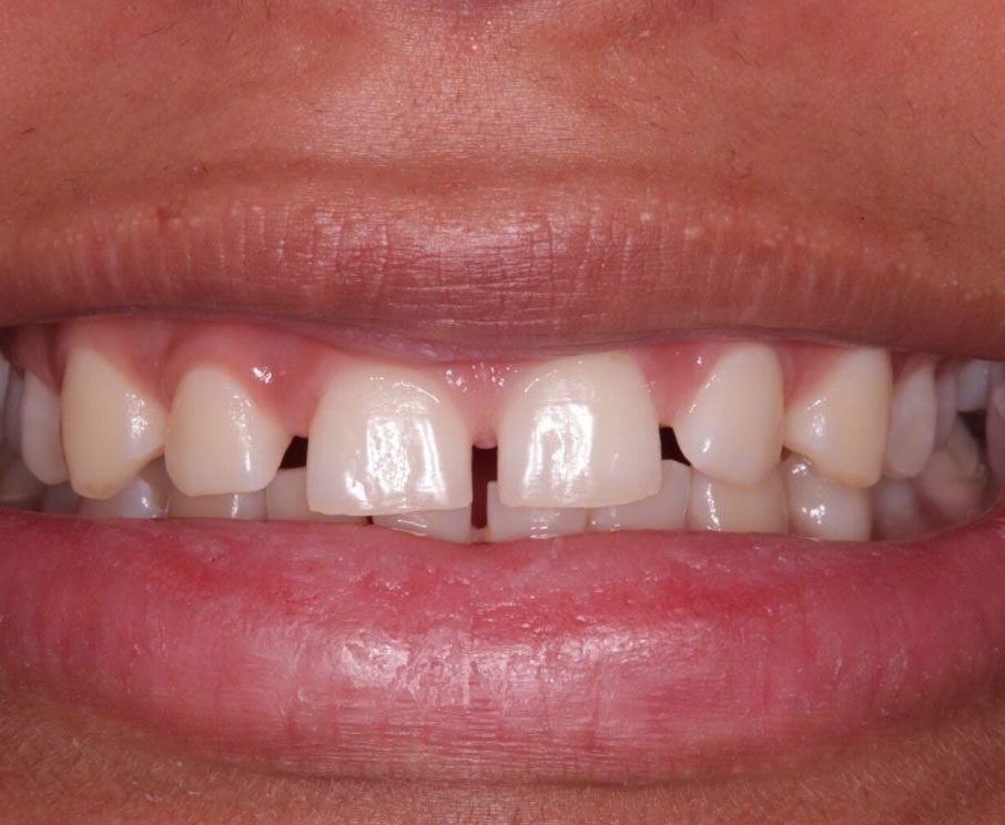Space in Teeth