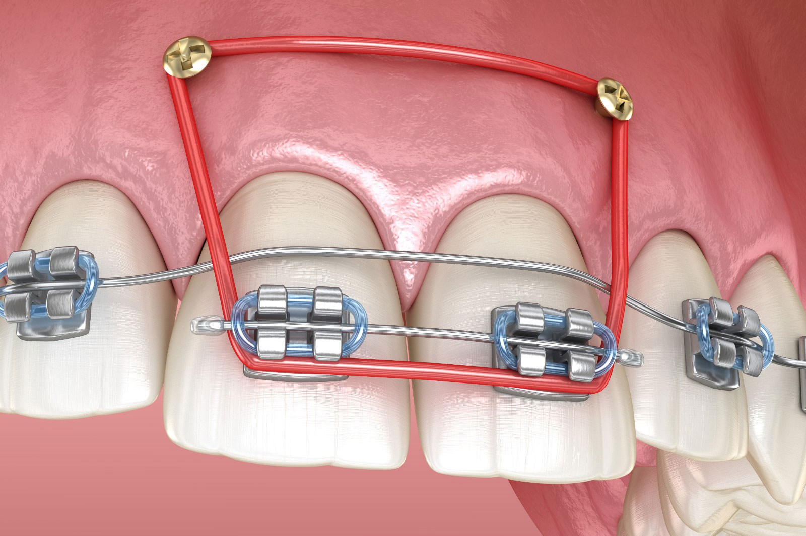 Anchorage in Orthodontics
