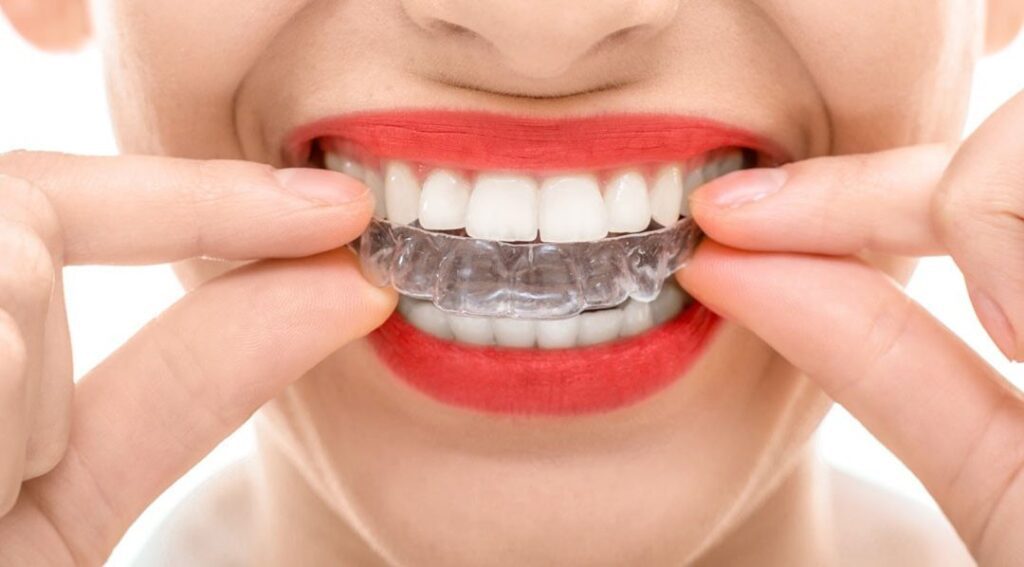 Orthodontics with invisalign