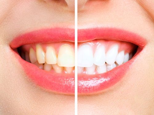 Yellow Teeth