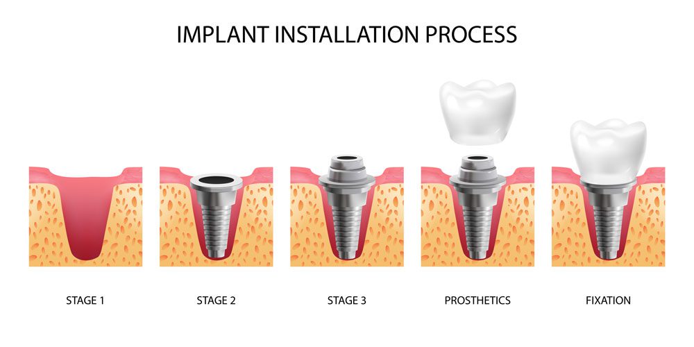 Implant Consultation