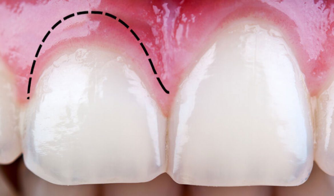 Gummy Smile Correction