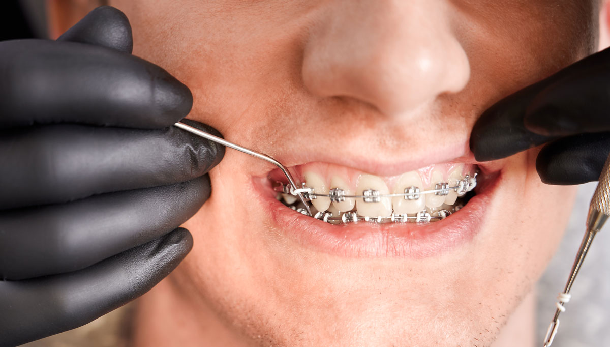 types of braces