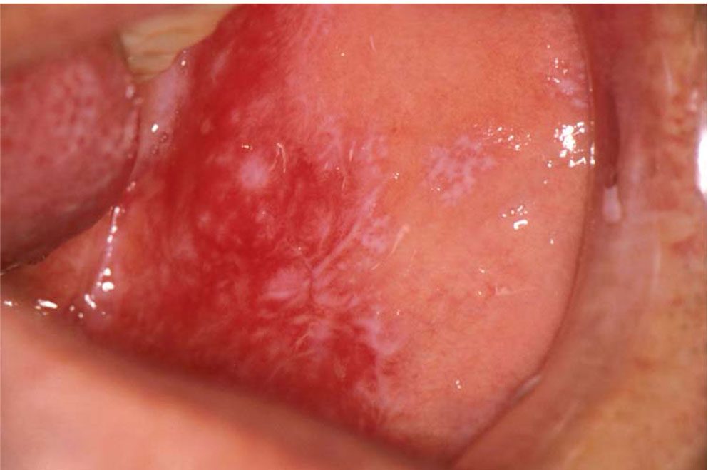 Oral lichen planus