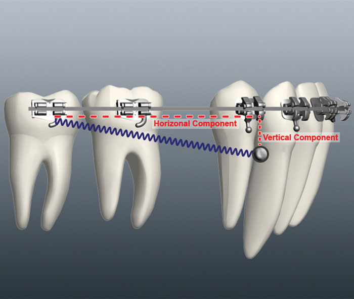 Anchorage in Orthodontics